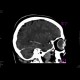 Retinal detachment: CT - Computed tomography